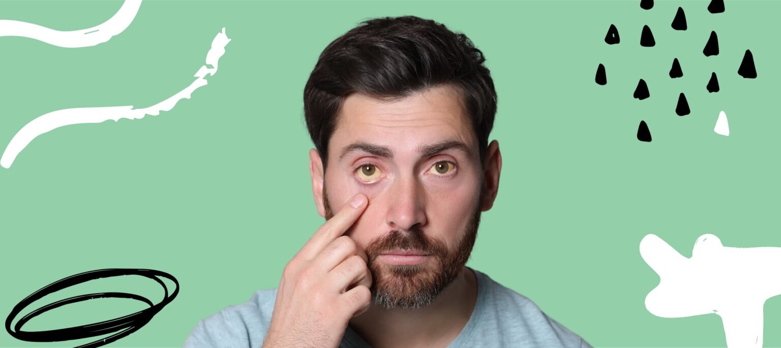 Causes of Eye Discoloration in the White Part