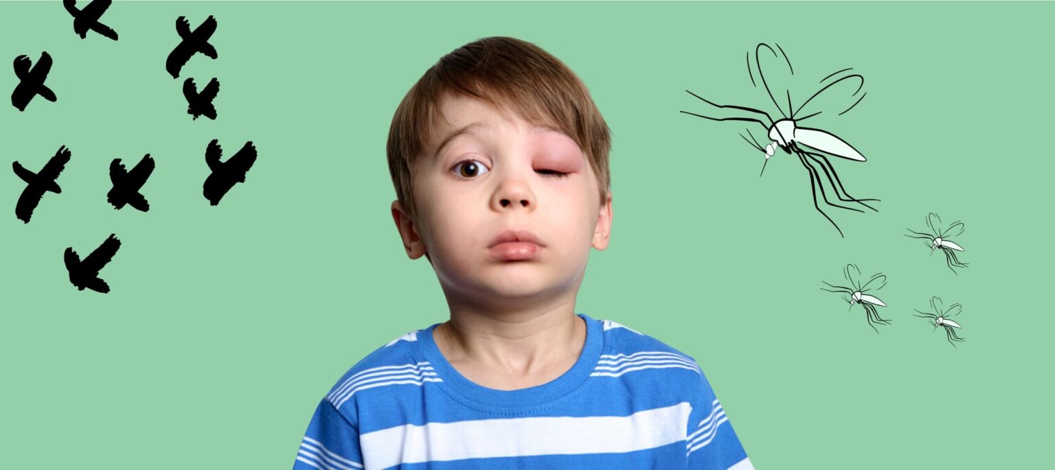 child with mosquito bite on eyelid