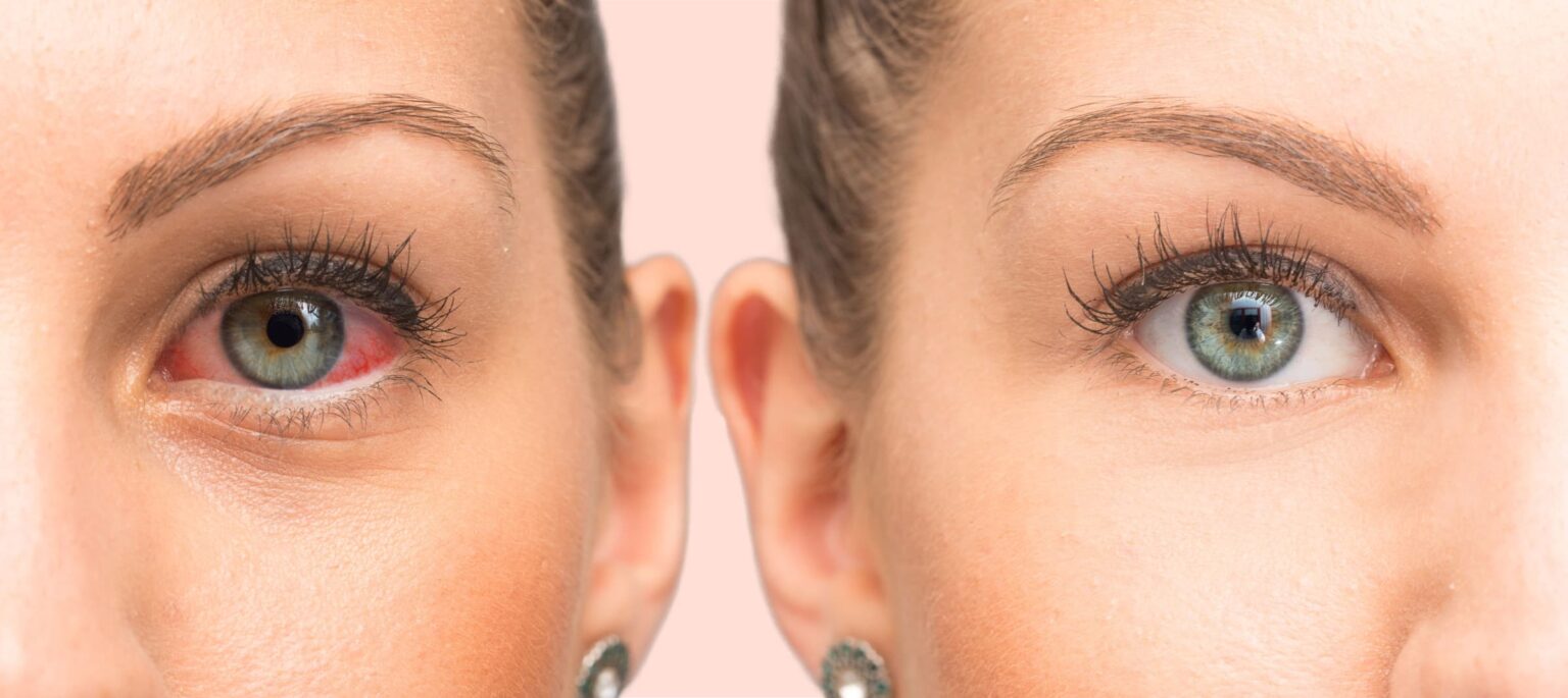 Pink Eye Vs Dry Eye